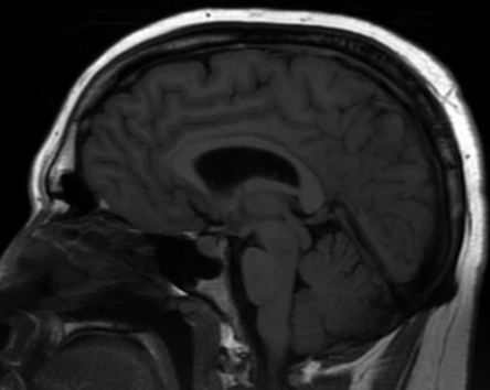 Sagittal T1 FLAIR suggested descent of mammillary bodies and posterior fossa crowding.
