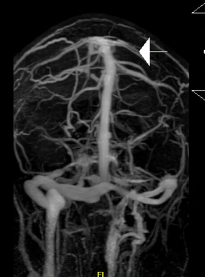 MR Venogram (MRV): Distention of venous sinuses, particularly on the right; no thrombosis identified.